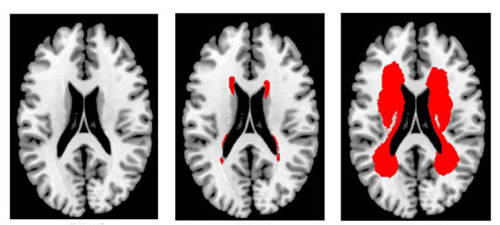 65~74세 뇌경색 환자의 대뇌부챗살(운동•감각신경이 지나는 대뇌 중앙 부위) MRI 사진의 등급별 비교: 1등급(왼쪽)의 경우 혈관 손상이 거의 보이지 않으며, 50등급(가운데)은 중앙혈관 일부에 손상이 보이고 100등급(오른쪽)은 중앙 혈관 상당부분이 손상됐음을 알 수 있다. 사진 붉은색 부분이 손상된 뇌 혈관.