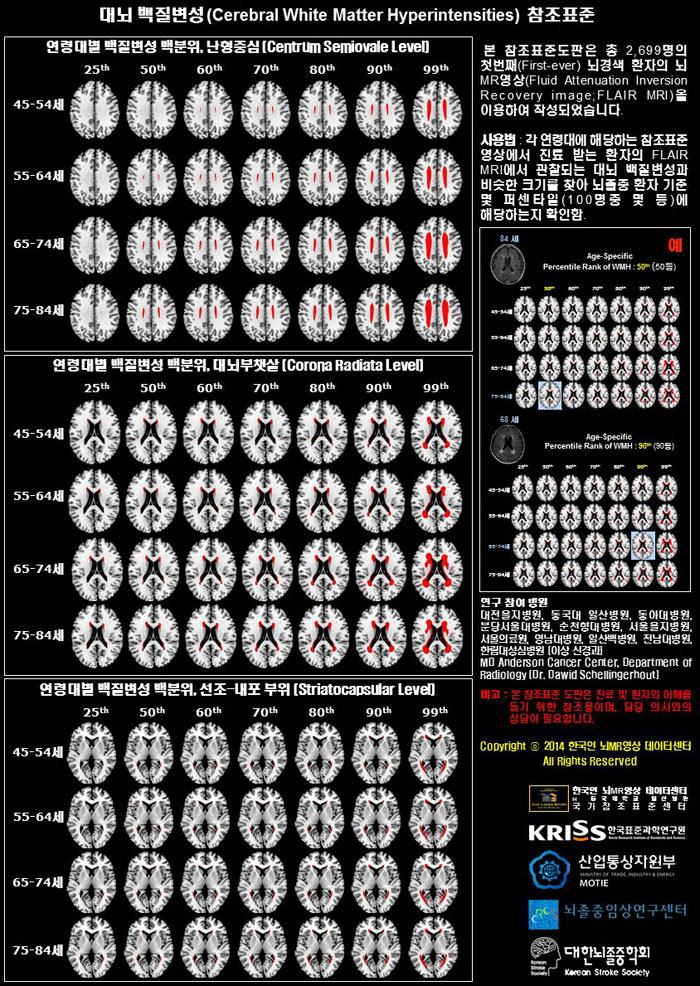 한국표준과학연구원이 한국의 11개 대학병원과 공동 개발한 ‘한국인 허혈 뇌지도’를 의료용 참조표준도판으로 만든 모습. 환자의 MRI사진과 비교하면 뇌경색 위험 정도를 알 수 있다.