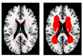 65~74세 뇌경색 환자의 대뇌부챗살(운동•감각신경이 지나는 대뇌 중앙 부위) MRI 사진